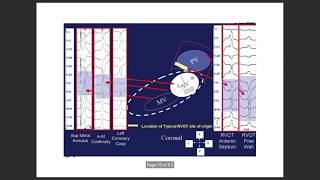 Ventricular tach localisation by ecg VTlocalisation ventriculartachycardia VPC [upl. by Fleur]