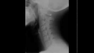 Cervical Spine Radiology Tutorial [upl. by Aig]