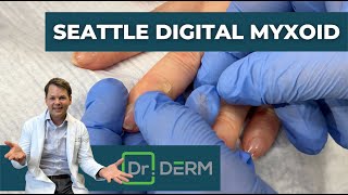 Digital Myxoid from Seattle  Dr Derm [upl. by Castra664]