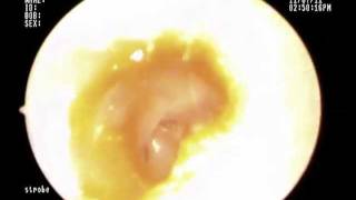 Total Ear Drum Perforation [upl. by Bondie]