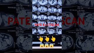 CT Scan Whole Abdomen Pure Pate Ka CT Scan radiology radiography reels shorts trending short [upl. by Raye]