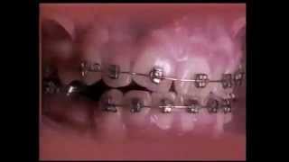 Straight teeth in a time lapse [upl. by Zel]