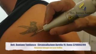 Rimozione tatuaggio Roma con laser Q SWITCHED REVLITE  Dott Tambasco [upl. by Eladnor]