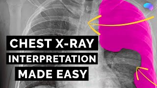 Chest Xray Interpretation  How to Read a CXR  OSCE Guide  UKMLA  CPSA [upl. by Euridice]