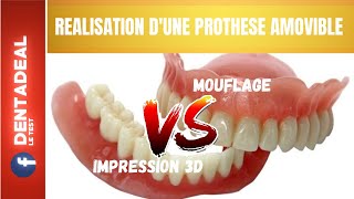 Prothèse Amovible Dentaire  IMPRESSION 3D VS MOUFLAGE [upl. by Atteuqram]