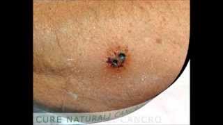 Skin cancer cured without radiation or surgery [upl. by Ecadnac815]