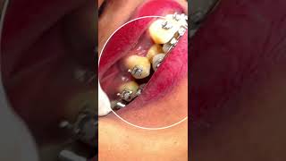 Making Space for Lateral Incisors  Orthodontic Insights dentist shorts [upl. by Hplodnar274]