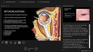 Retinoblastoma Dr Juan Jose Perez Radiologo 20240426 [upl. by Anialad]