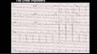 1215 Lead ECG MI Imposter 3 [upl. by Dweck]