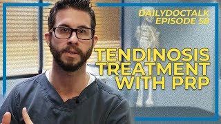 Tendinosis Treatment with PRP  DailyDocTalk 58 [upl. by Yenitsed]