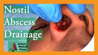 Nostril Abscess Drainage  Auburn Medical Group [upl. by Reine]