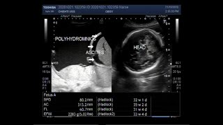 Ultrasound Video showing a Pregnancy of 32 weeks with Polyhydromnios ascites and sluggish fetus [upl. by Odnomar175]