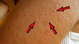 Natural Treatment to Get Rid of Keratosis Pilaris Chicken Skin [upl. by Nedyarb]