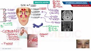 Otorrinolaringología  Sinusitis aguda [upl. by Nolie981]