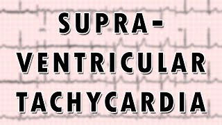 Supraventricular Tachycardia [upl. by Hplodur]