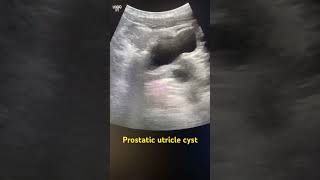 Prostatic utricle cyst prostatetrasound radiology radiography ultrasoundmadeeasy [upl. by Hazen]