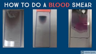 How to Prepare a Peripheral Blood Smear Hematopathology amp Hematology with Dr Jeanette Ramos [upl. by Om]