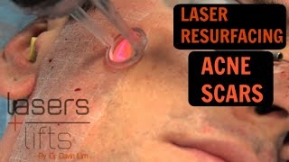 HOW TO TREAT ACNE SCARS  Laser resurfacing and TCA CROSS [upl. by Yolane267]