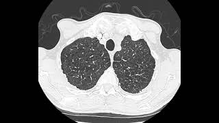 Enfisema pulmonar centrilobular [upl. by Ahsiuqram]