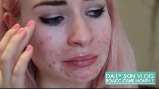 Roaccutane Daily Skin Vlog  Month 1 [upl. by Teece872]