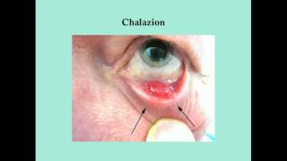 Disorders of the Eye Lid  CRASH Medical Review Series [upl. by Essex]