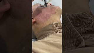 Erase Scars Fast with CO2 Fractional Laser Treatment shortvideo scarremoval [upl. by Blynn]