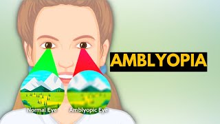 Amblyopia Causes Signs and Symptoms Diagnosis and Treatment [upl. by Cutler]