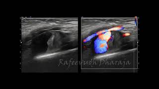 Axillary artery Pseudoaneurysm [upl. by Adnohsirk]