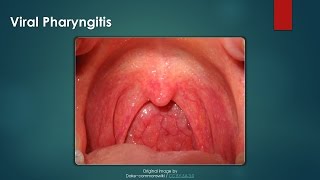 Viral Pharyngitis [upl. by Ellinnet]