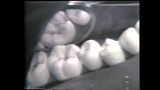 688 Class II Mesio Occlusal Cavity Preparation for Amalgam [upl. by Read328]