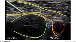 Ultrasound Guided Fascia Iliaca Block [upl. by Orren522]