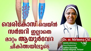 വെരികോസ് വെയ്ൻ സർജറി ഇല്ലാതെ മാറ്റം ആയുർവേദ ചികിത്സയിലൂടെ  Dr Sr Nirleena CSC ദേഹം ദേവാലയം Epi10 [upl. by Oys]