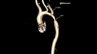 Coarctation of aorta [upl. by Hluchy]