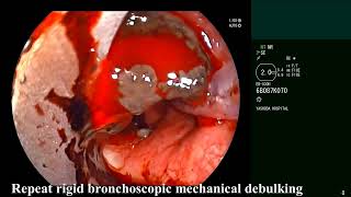 Tracheal Melanoma  Central Airway Obstruction Rigid bronchoscopic debulking [upl. by Anomis230]