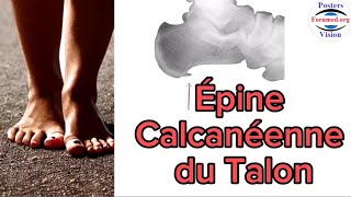 Épine Calcanéenne au Talon douleurs du pied fasciite de Aponévrose plantaire [upl. by Suiremed]