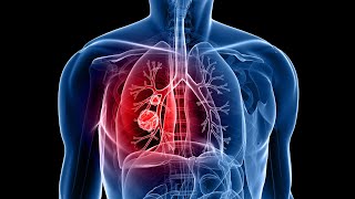 Adenocarcinoma transformation to small cell lung cancer with C797S acquire resistance to osimertinib [upl. by Fifine357]