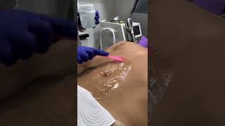 👉Depilación rápida y sin dolor ✨ depilacionlaser depilacion depilar alania clinicalania [upl. by Yevad]