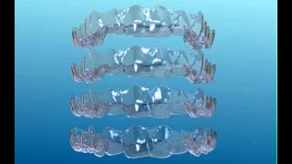 Orthodontic Clear aligners how aligners work invisalign [upl. by Fonseca]