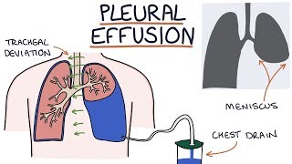 Understanding Pleural Effusions [upl. by Neal]