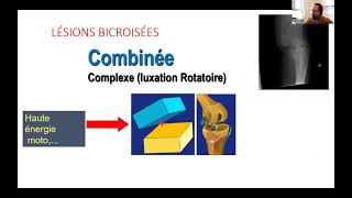 Luxation et lésions multiligamentaires du genou [upl. by Perl264]