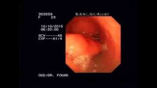 gastric plication stenosis endoscopy Dr Fouad Alahdab [upl. by Ahsinahs]