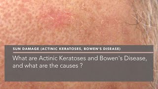 What are Actinic Keratoses and Bowens Disease and what are the causes [upl. by Howzell]