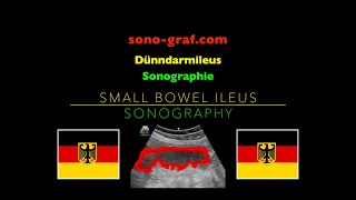 Sonographie  Dünndarmileus [upl. by Ailey]