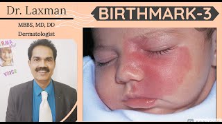 Birthmarks  Birthmark3  Port Wine Stain  Sebaceous Nevus  White Mole  Pimple Gland  Oil Gland [upl. by Aynekat]