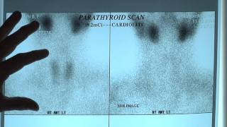 What are Sestamibi Scans Positive amp Negative Sestamibi Parathyroid Scans [upl. by Linus]