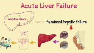 Acute Liver Failure Or Fulminant Hepatic Failure  Sign Symtoms  Causes  Risk Factors  Treatment [upl. by Notneuq]