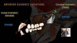 Occlusal equilibration [upl. by Icaj585]