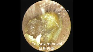 NO2023092404 Earwax removal耳垢去除（Lots of earwax好多耳屎） [upl. by Janetta]