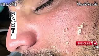 blackheads extractions blackheads and whiteheads removal blackheads new this week [upl. by Drolet634]