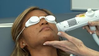 New Acne Laser for Darker Skin [upl. by Lidaa]